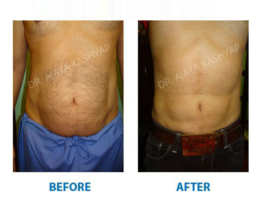 Body Contouring Surgery in India